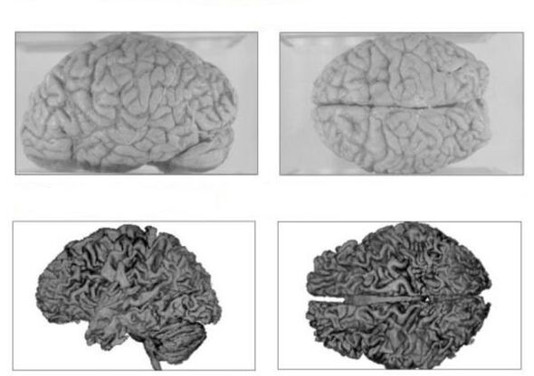 Mózg osoby zdrowej (góra) i mózg alkoholika z nieodwracalnymi konsekwencjami (dół)